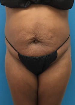 Tummy Tuck in Friendswood & League City Before & After Photos