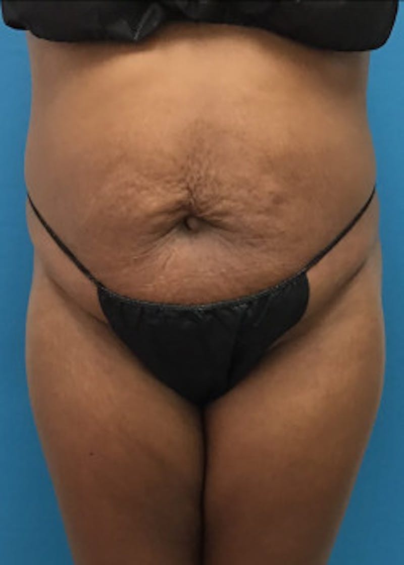 Tummy Tuck Before & After Gallery - Patient 46612023 - Image 1