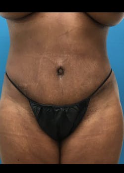 Tummy Tuck in Friendswood & League City Before & After Photos