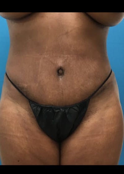 Tummy Tuck Before & After Gallery - Patient 46612023 - Image 2