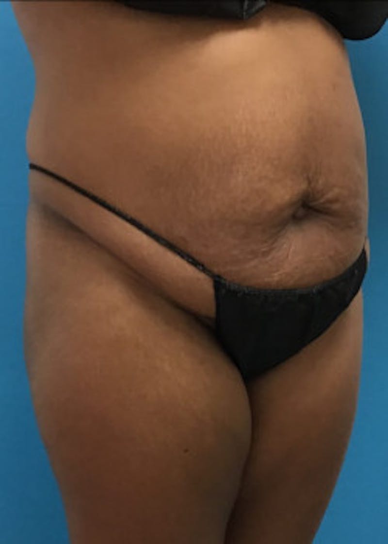 Tummy Tuck Before & After Gallery - Patient 46612023 - Image 3