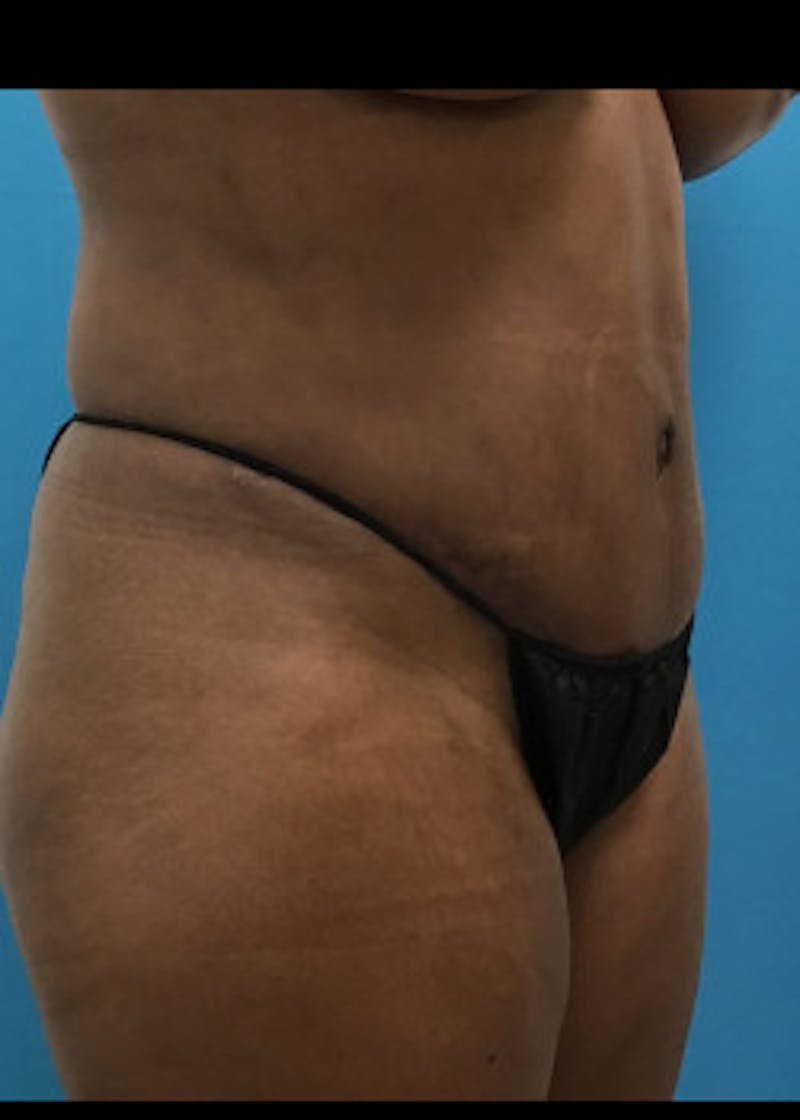 Tummy Tuck Before & After Gallery - Patient 46612023 - Image 4