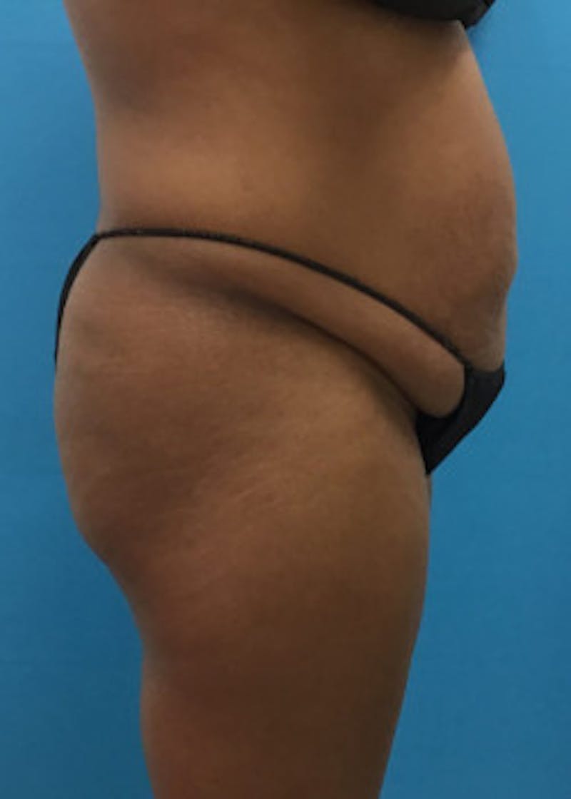 Tummy Tuck Before & After Gallery - Patient 46612023 - Image 5