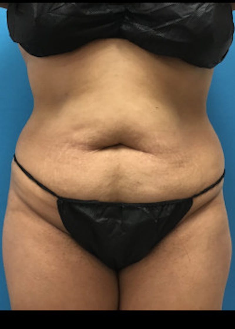 Tummy Tuck Before & After Gallery - Patient 46612032 - Image 1