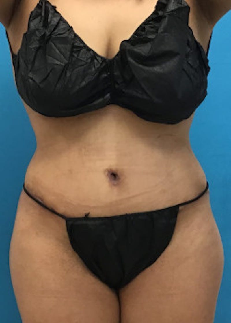 Tummy Tuck Before & After Gallery - Patient 46612032 - Image 2