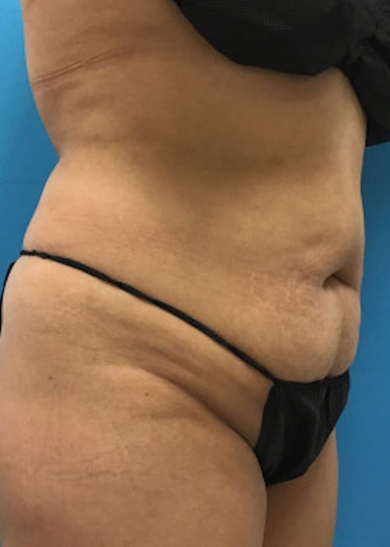 Tummy Tuck Before & After Gallery - Patient 46612032 - Image 3