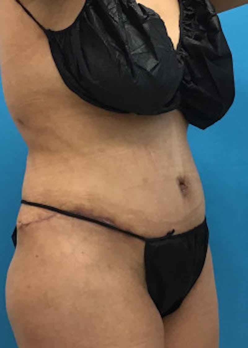 Tummy Tuck Before & After Gallery - Patient 46612032 - Image 4