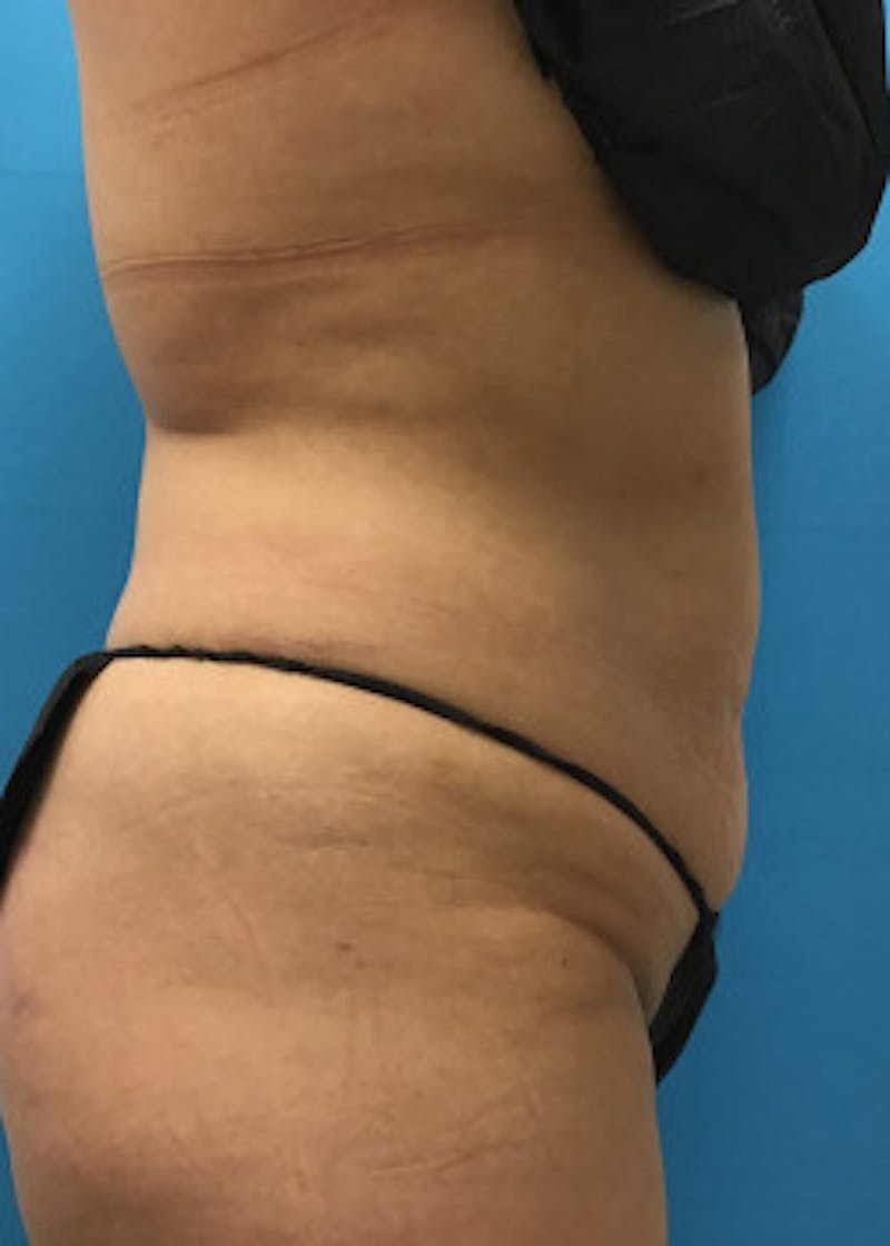 Tummy Tuck Before & After Gallery - Patient 46612032 - Image 5