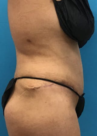 Tummy Tuck Before & After Gallery - Patient 46612032 - Image 6