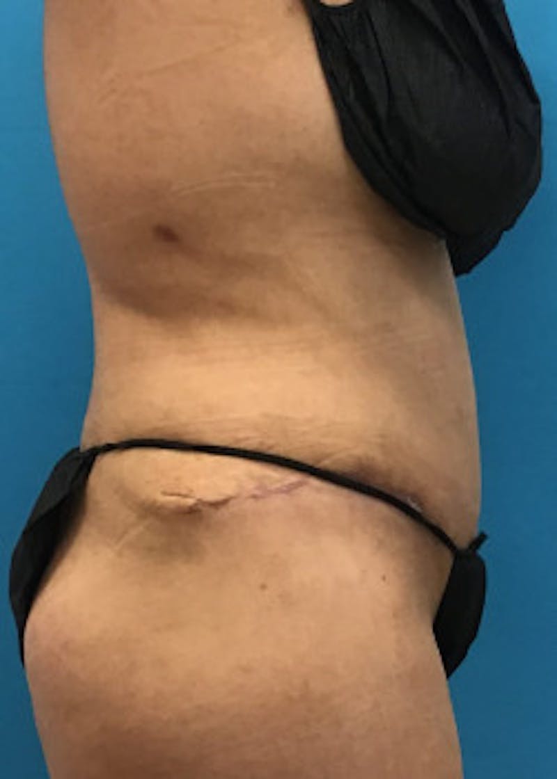 Tummy Tuck Before & After Gallery - Patient 46612032 - Image 6
