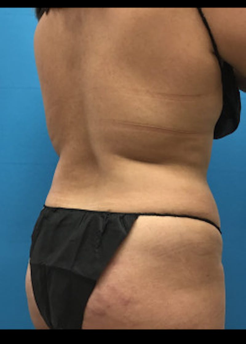 Tummy Tuck Before & After Gallery - Patient 46612032 - Image 7