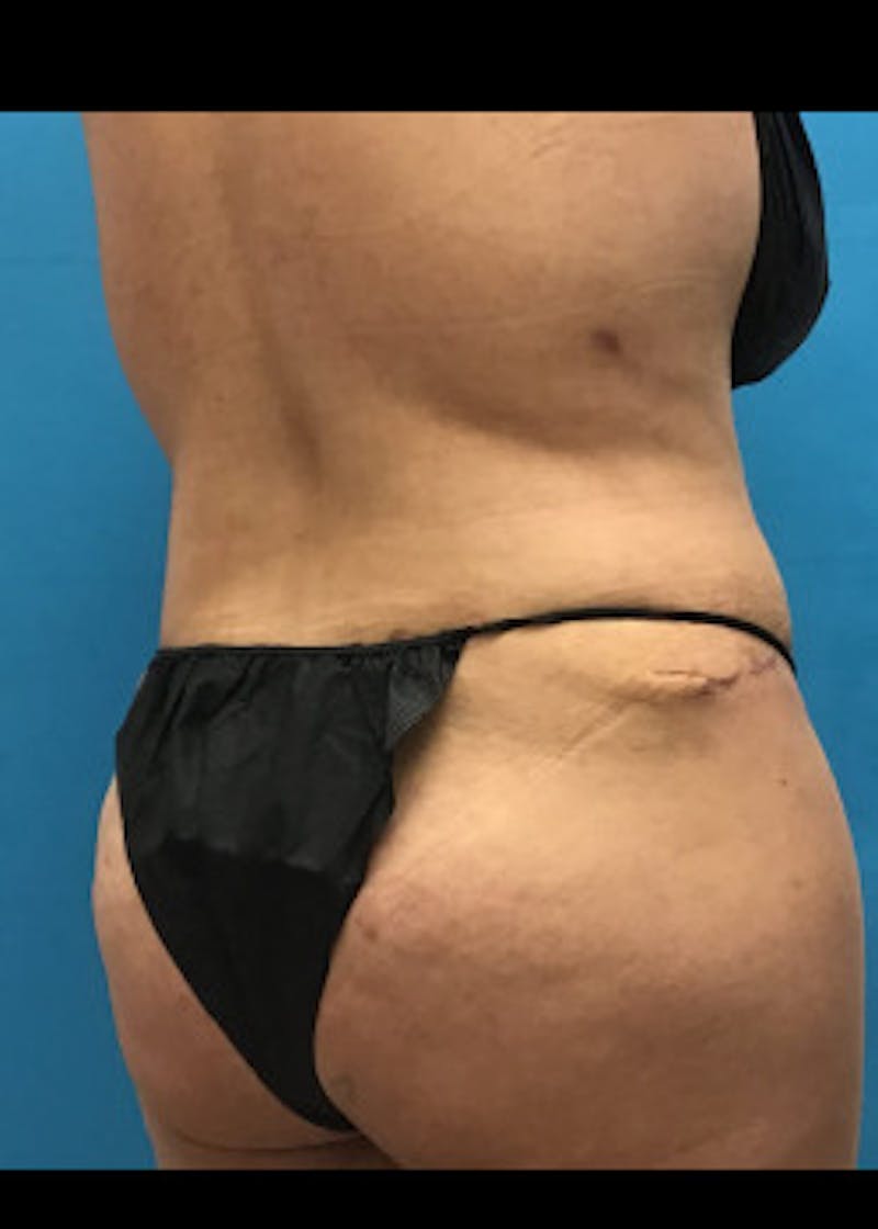 Tummy Tuck Before & After Gallery - Patient 46612032 - Image 8
