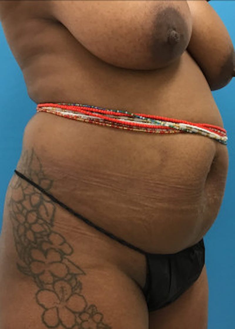 Tummy Tuck Before & After Gallery - Patient 46612034 - Image 3