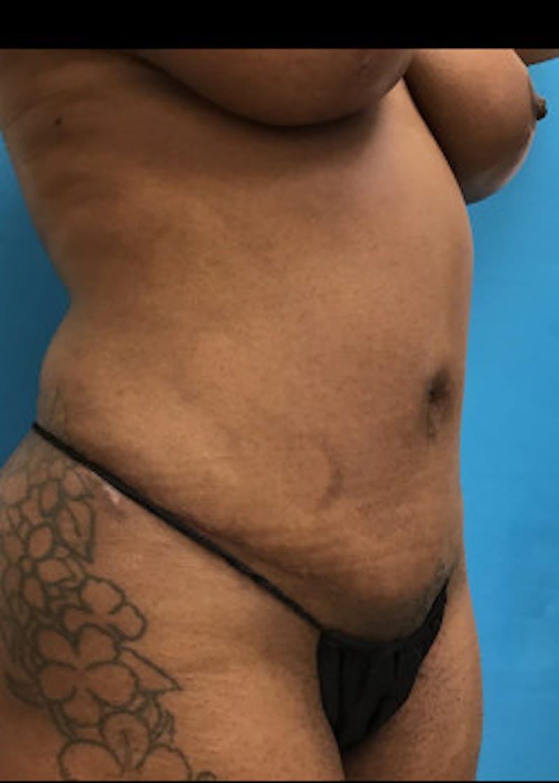 Tummy Tuck Before & After Gallery - Patient 46612034 - Image 4