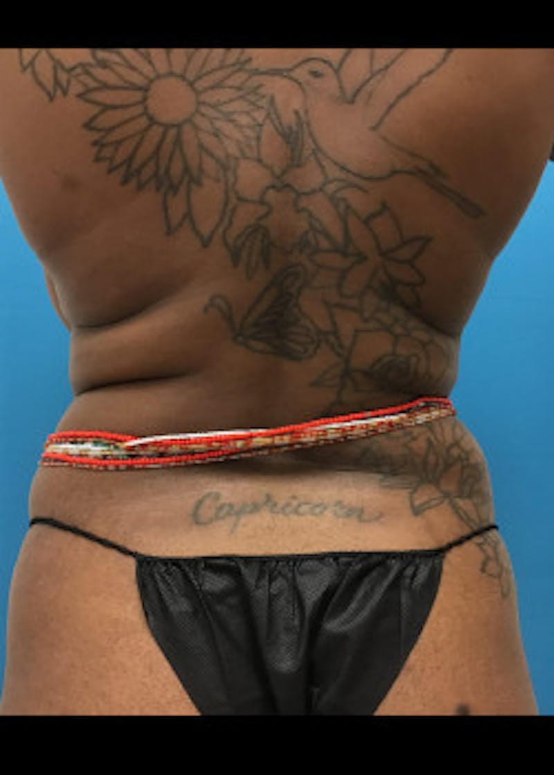 Tummy Tuck Before & After Gallery - Patient 46612034 - Image 5