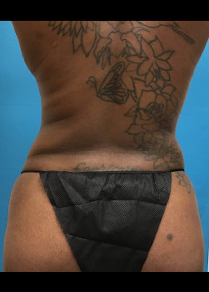 Tummy Tuck Before & After Gallery - Patient 46612034 - Image 6