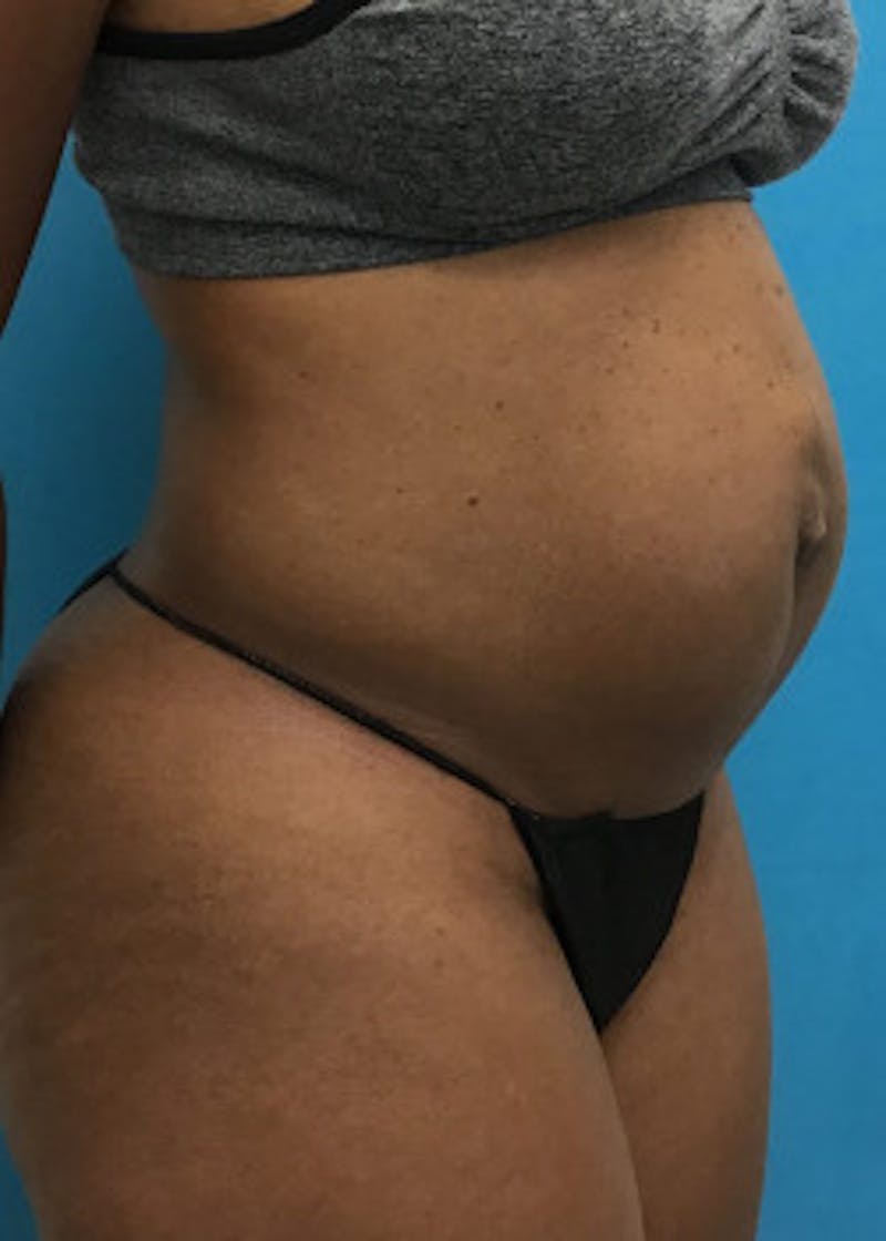 Tummy Tuck Before & After Gallery - Patient 46612040 - Image 1