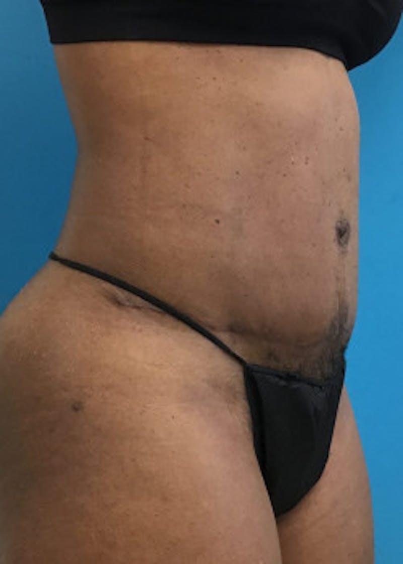 Tummy Tuck Before & After Gallery - Patient 46612040 - Image 2