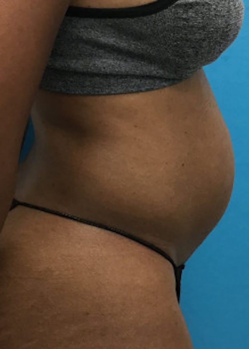 Tummy Tuck Before & After Gallery - Patient 46612040 - Image 3