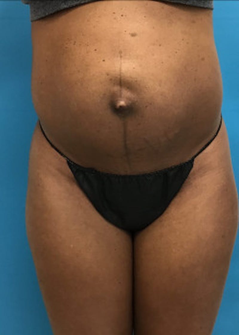Tummy Tuck Before & After Gallery - Patient 46612040 - Image 5