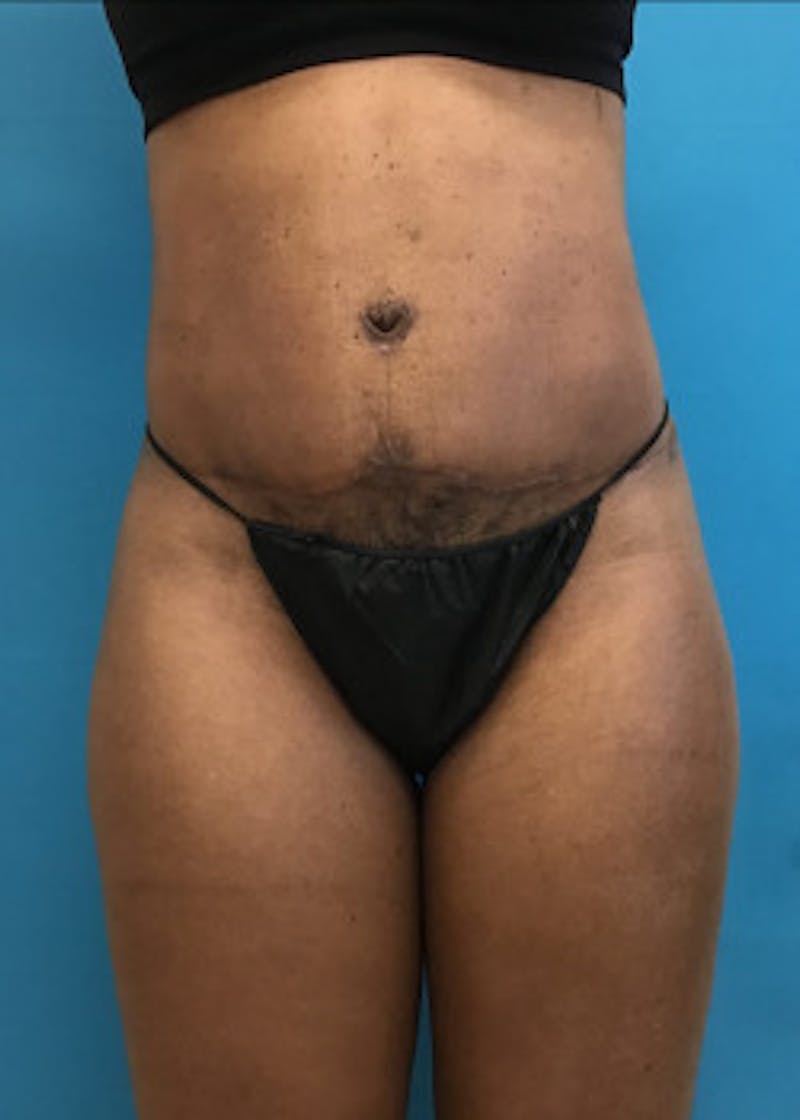 Tummy Tuck Before & After Gallery - Patient 46612040 - Image 6