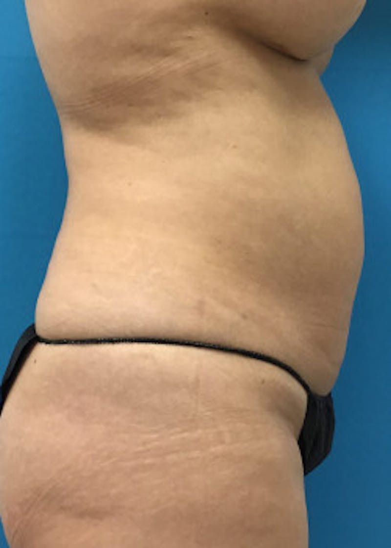 Tummy Tuck Before & After Gallery - Patient 46612041 - Image 1