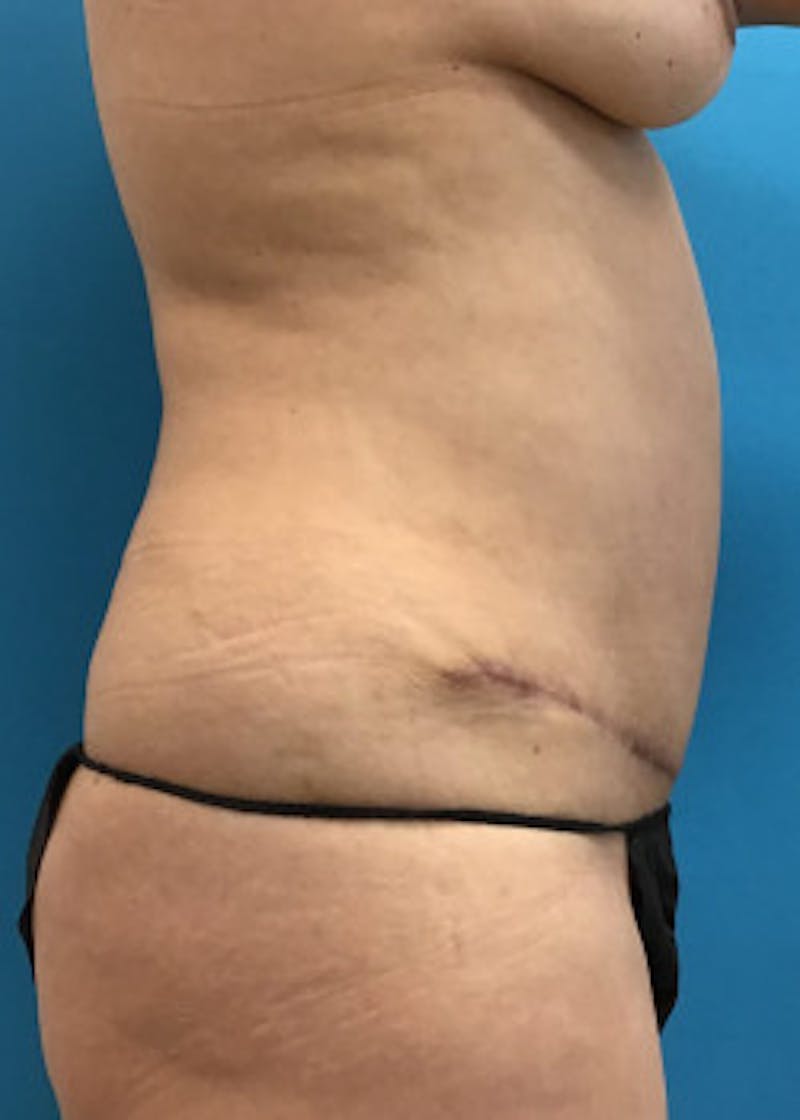 Tummy Tuck Before & After Gallery - Patient 46612041 - Image 2