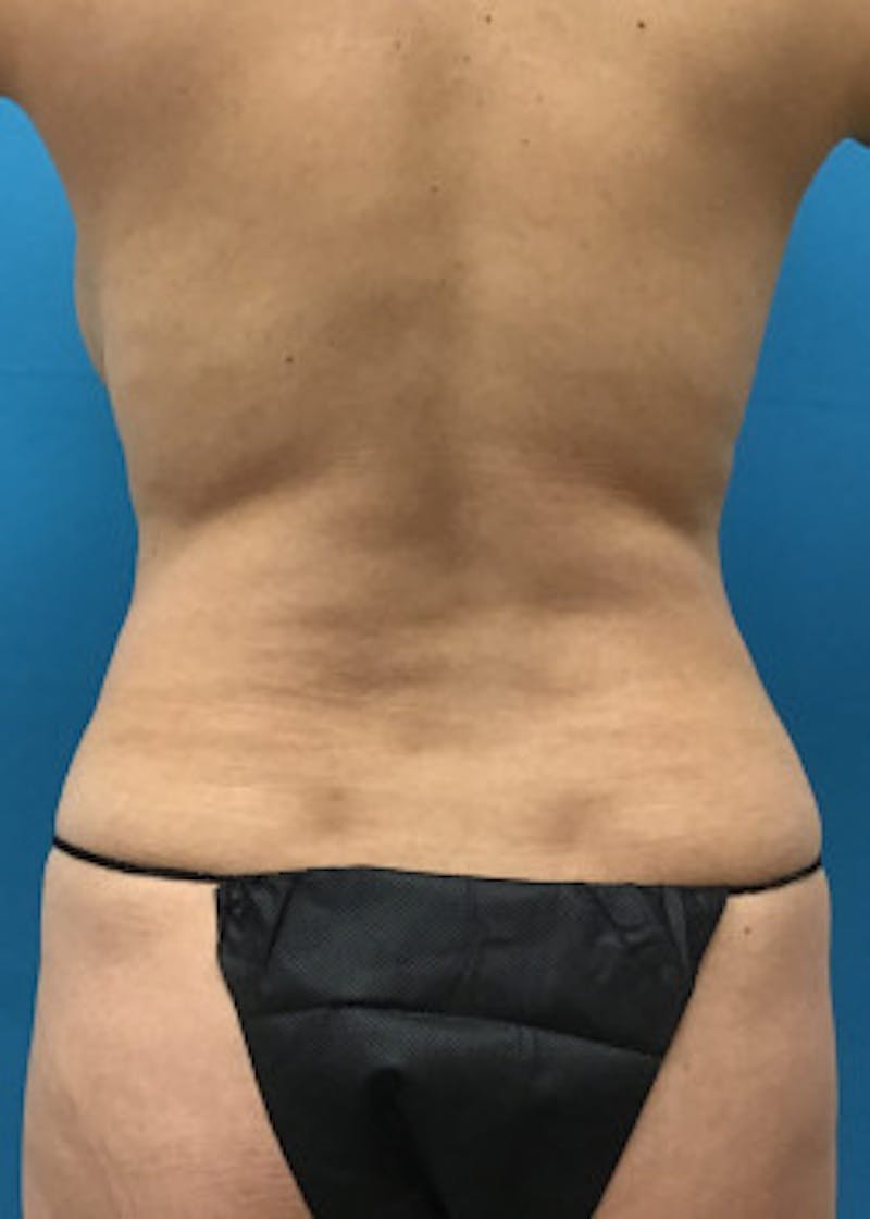 Tummy Tuck Before & After Gallery - Patient 46612041 - Image 3