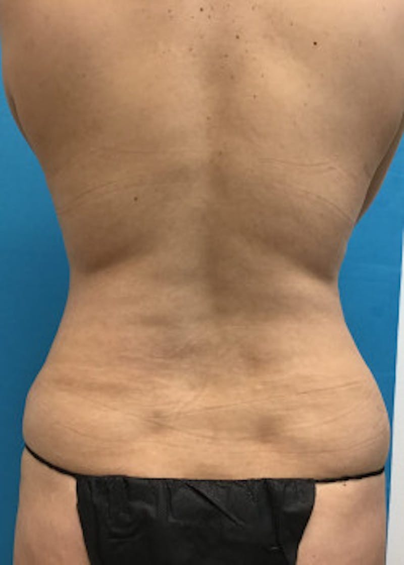 Tummy Tuck Before & After Gallery - Patient 46612041 - Image 4