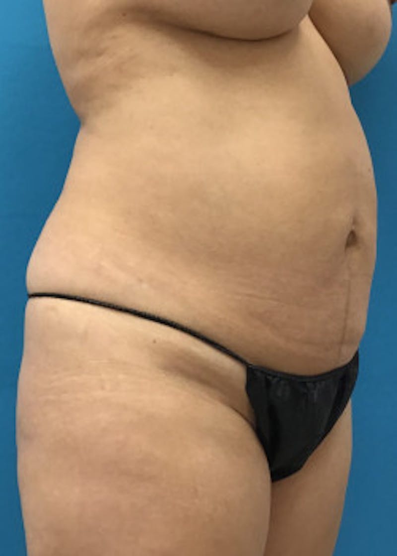Tummy Tuck Before & After Gallery - Patient 46612041 - Image 5