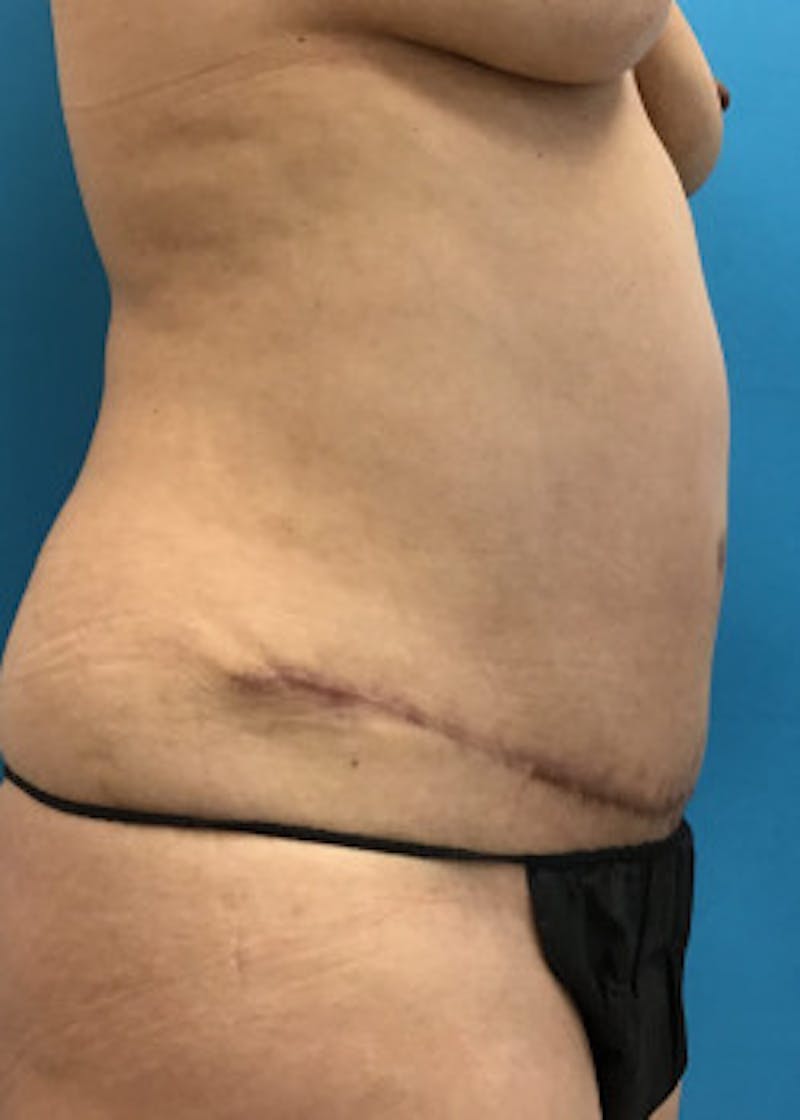 Tummy Tuck Before & After Gallery - Patient 46612041 - Image 6