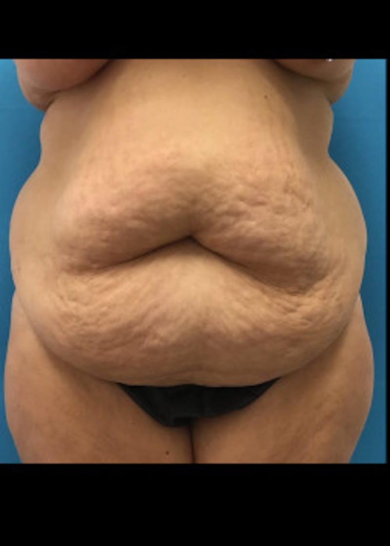 Tummy Tuck Before & After Gallery - Patient 46612047 - Image 1