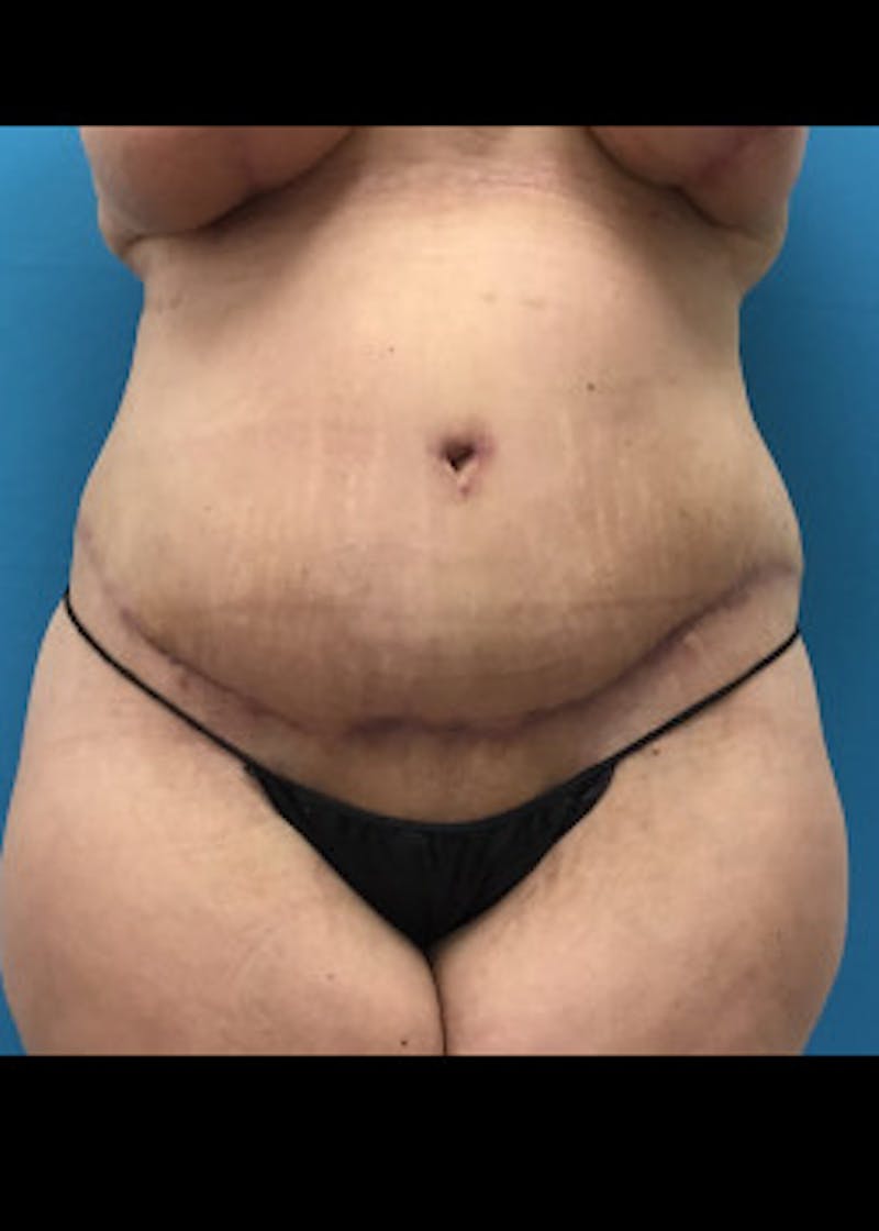 Tummy Tuck Before & After Gallery - Patient 46612047 - Image 2