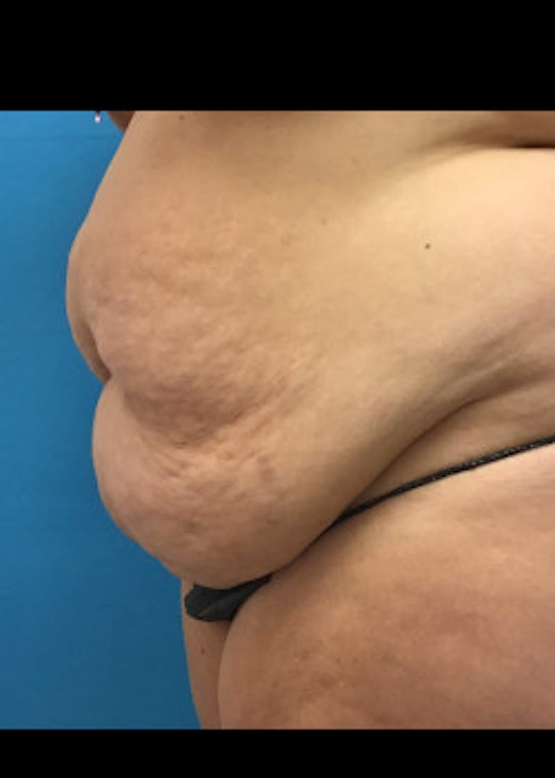 Tummy Tuck Before & After Gallery - Patient 46612047 - Image 3