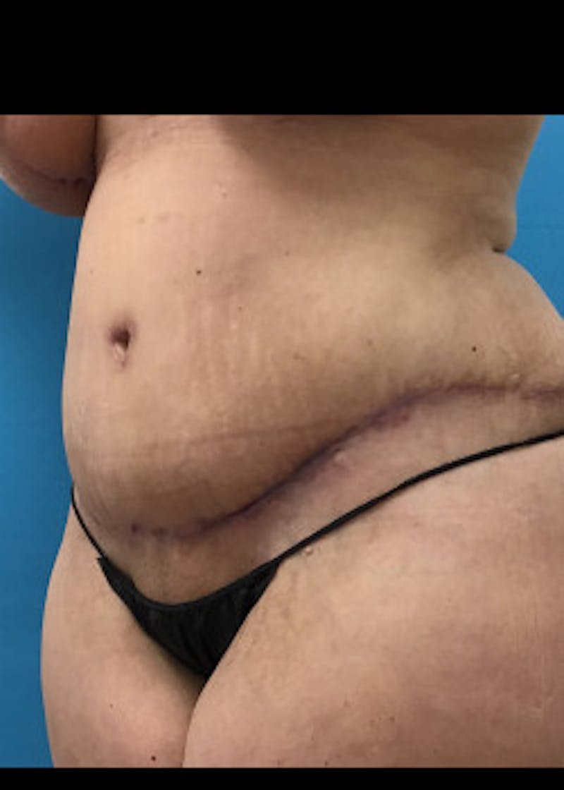 Tummy Tuck Before & After Gallery - Patient 46612047 - Image 4