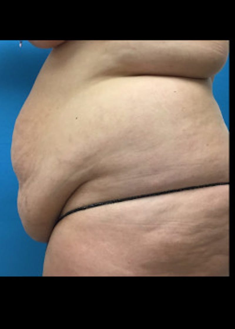 Tummy Tuck Before & After Gallery - Patient 46612047 - Image 5