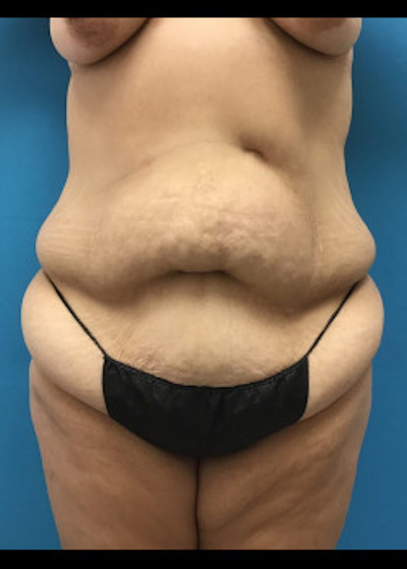 Tummy Tuck Before & After Gallery - Patient 46612070 - Image 1