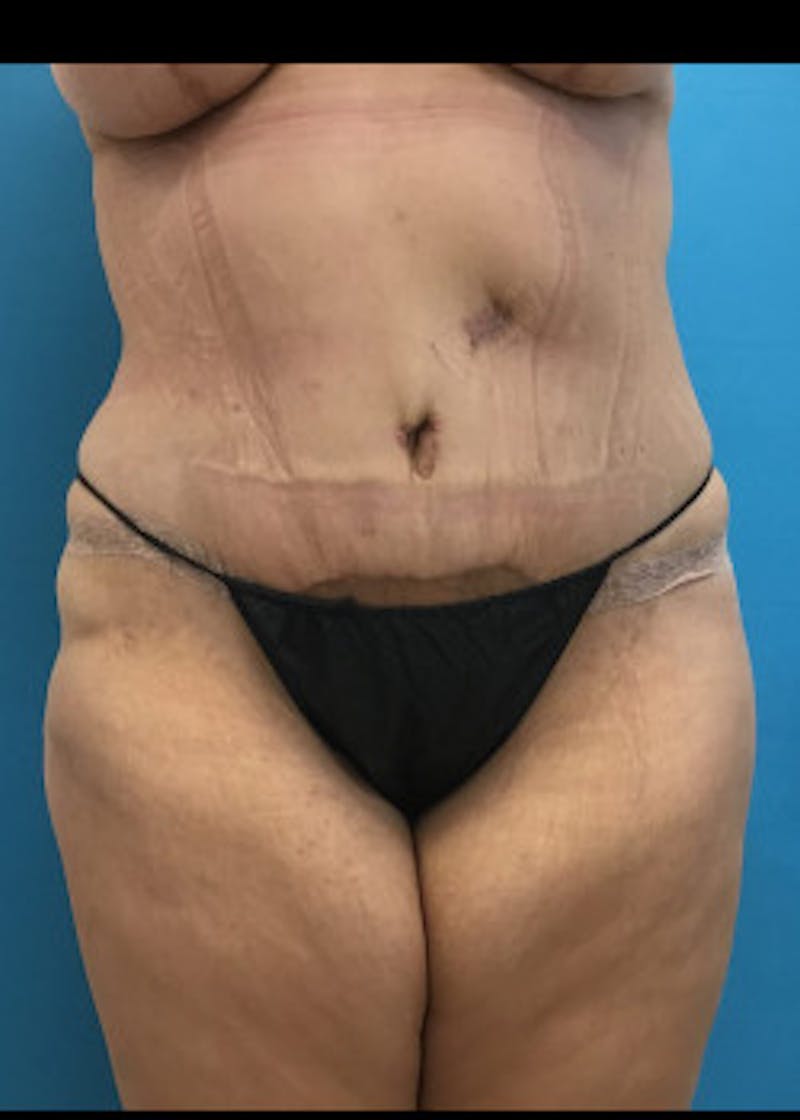 Tummy Tuck Before & After Gallery - Patient 46612070 - Image 2