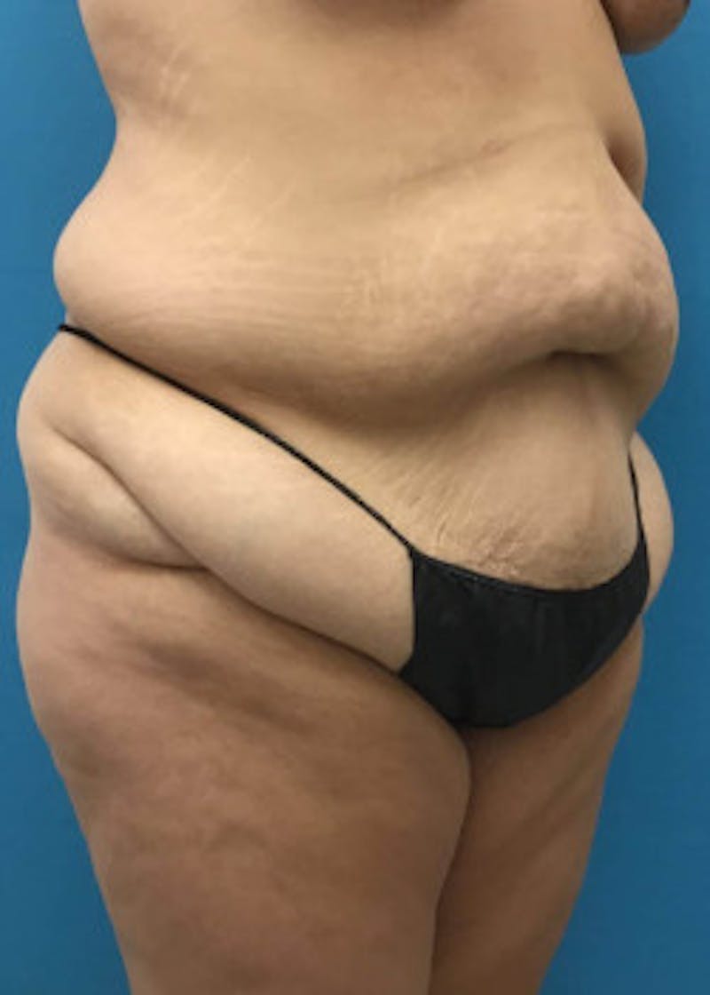 Tummy Tuck Before & After Gallery - Patient 46612070 - Image 3