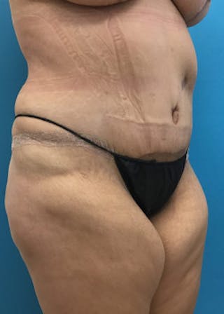 Tummy Tuck Before & After Gallery - Patient 46612070 - Image 4