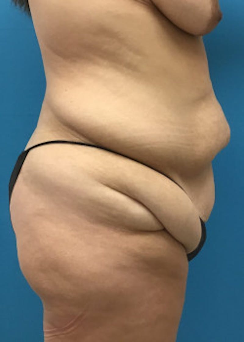 Tummy Tuck Before & After Gallery - Patient 46612070 - Image 5
