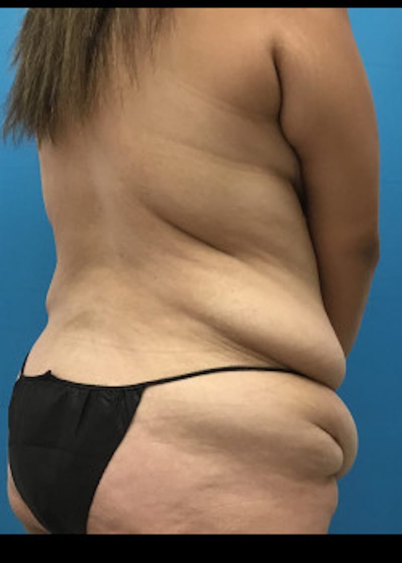 Tummy Tuck Before & After Gallery - Patient 46612070 - Image 7