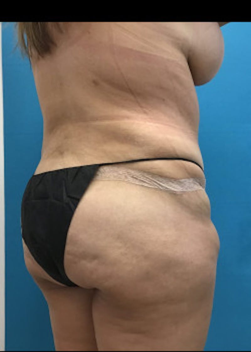 Tummy Tuck Before & After Gallery - Patient 46612070 - Image 8