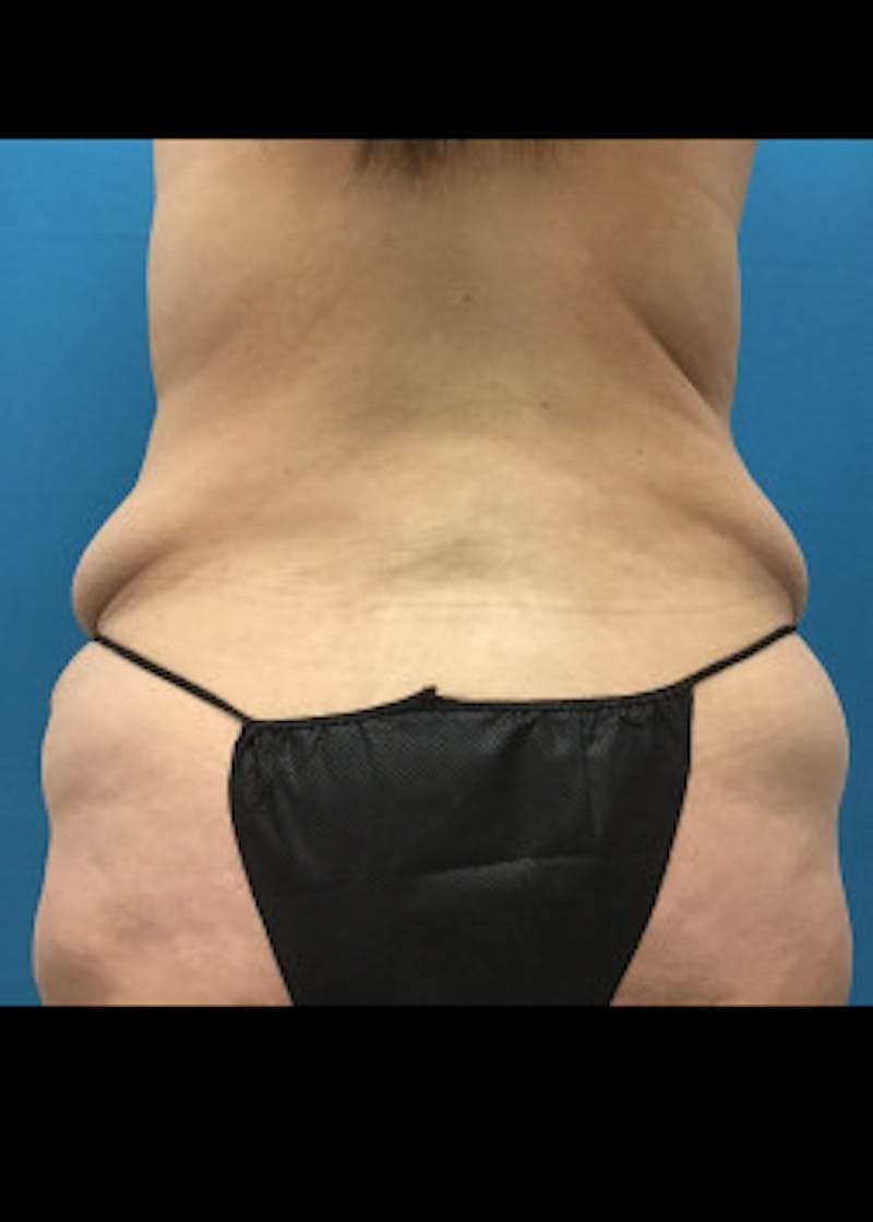 Tummy Tuck Before & After Gallery - Patient 46612070 - Image 9