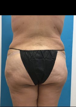 Tummy Tuck Gallery - Patient 46612070 - Image 10