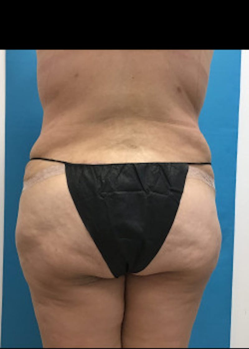 Tummy Tuck Before & After Gallery - Patient 46612070 - Image 10
