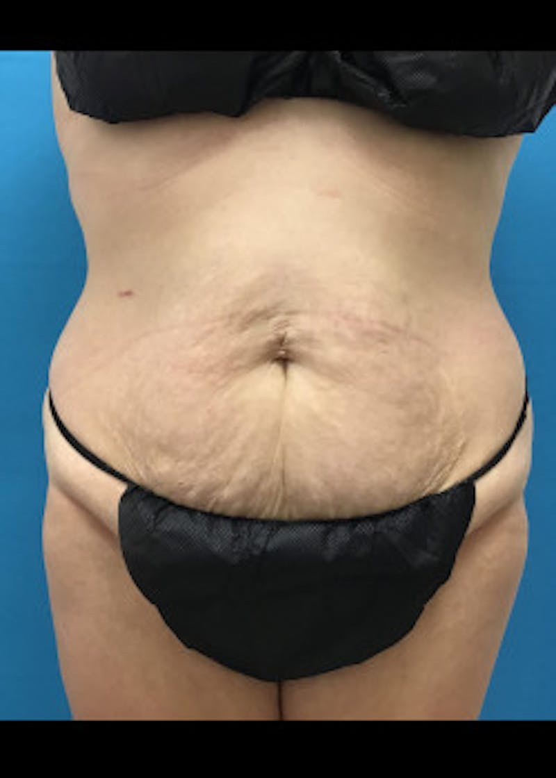 Tummy Tuck Before & After Gallery - Patient 46612080 - Image 1