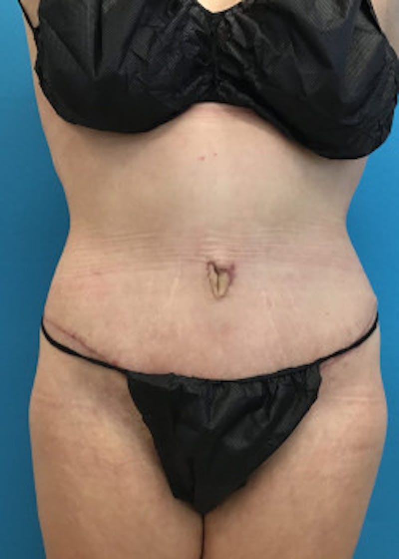 Tummy Tuck Before & After Gallery - Patient 46612080 - Image 2