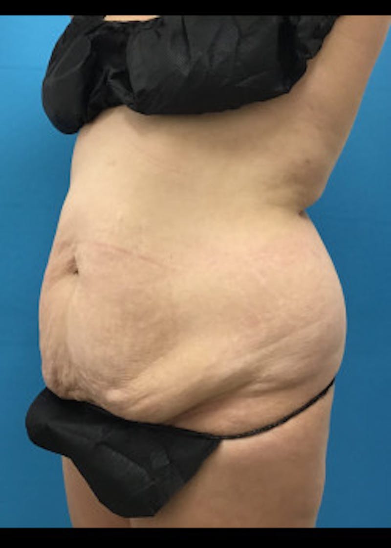 Tummy Tuck Before & After Gallery - Patient 46612080 - Image 3