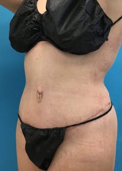 Tummy Tuck Gallery - Patient 46612080 - Image 4